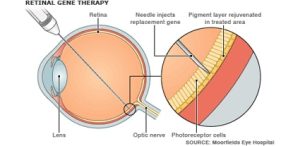 A graphic showing how gene therapy works