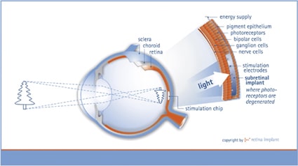 Detailed breakdown of the different layers of the eye and how a stimulation chip works