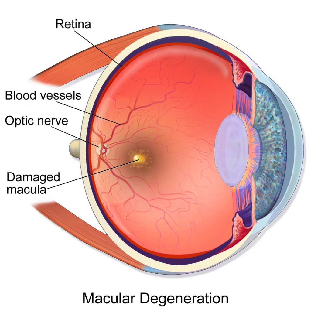 Medical illustration of a cross-section of the eye showing macular degeneration. The retina lines the back of the eye, and the central macula is highlighted as damaged. Labels point to the retina, blood vessels, optic nerve, and damaged macula.